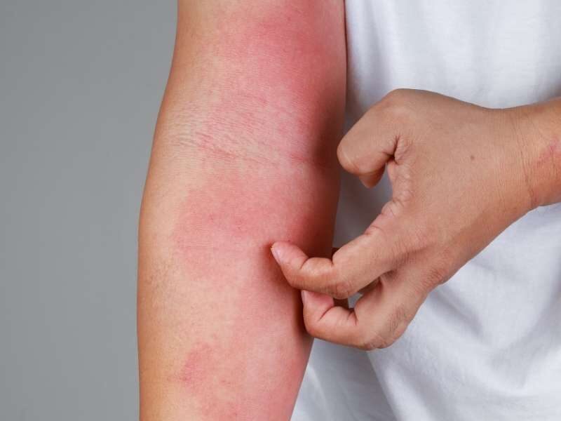 Pessoa com alergia e manchas vermelhas na pele.