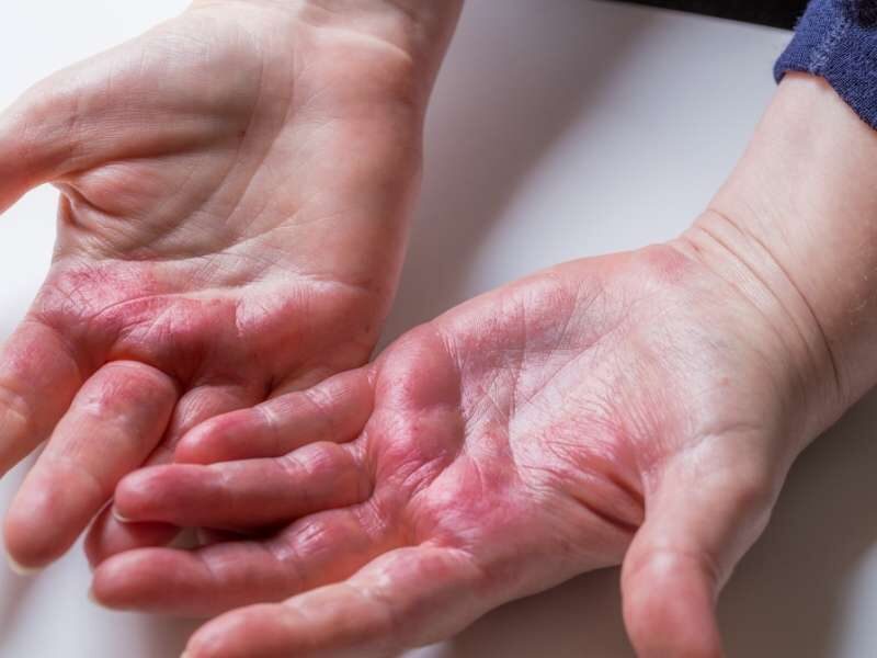 Dermatite atópica nas mãos.