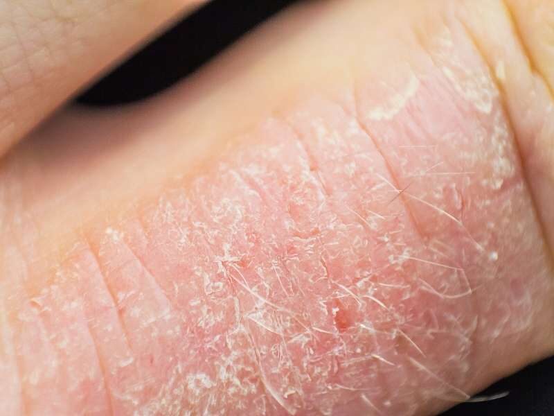 Eczema doença de pele.
