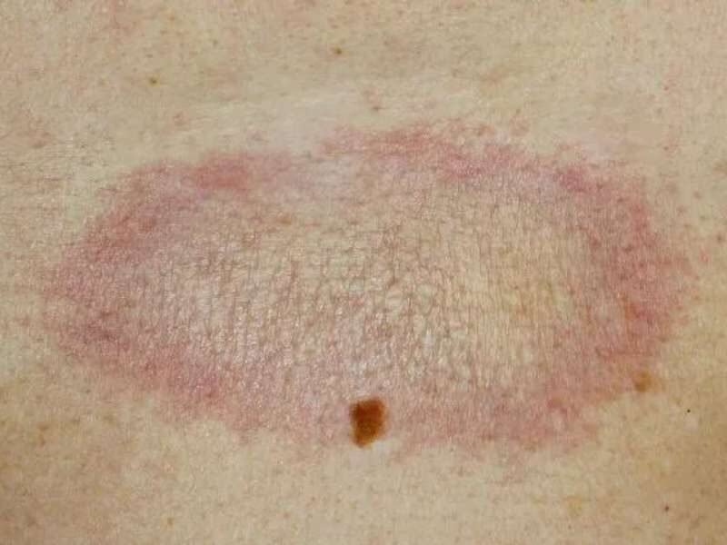  Esclerodermia cutânea.