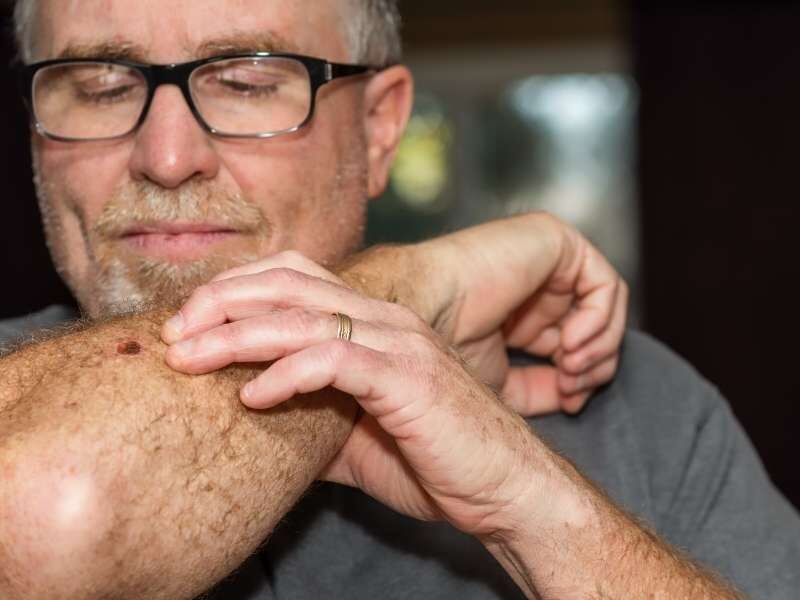 Homem com câncer de pele no braço.