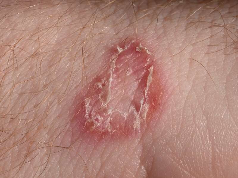 Pele com mancha de micose.