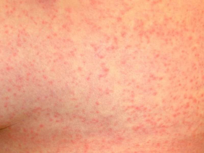 Zika vírus manchas vermelhas na pele.