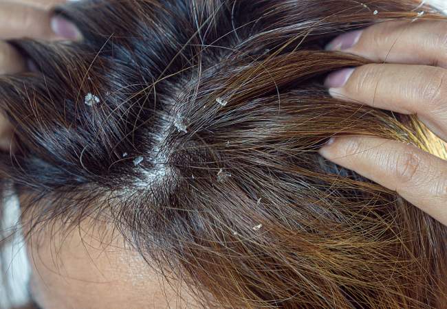 Tratamento natural contra psoríase