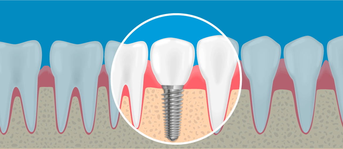 implante-dentario