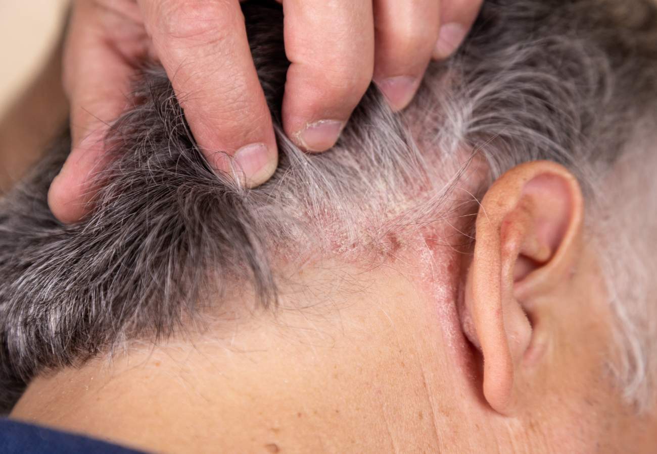 Psoriase capilar.
