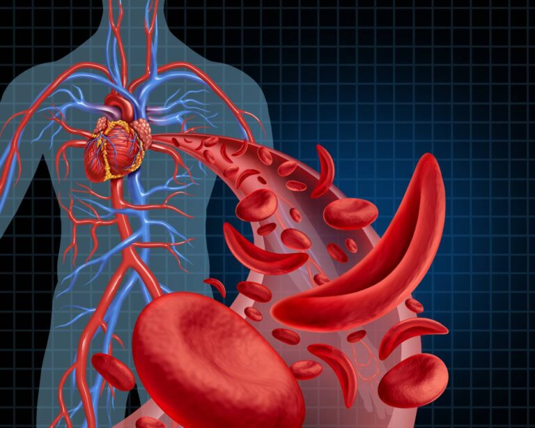 Veja as principais causas de anemia falciforme